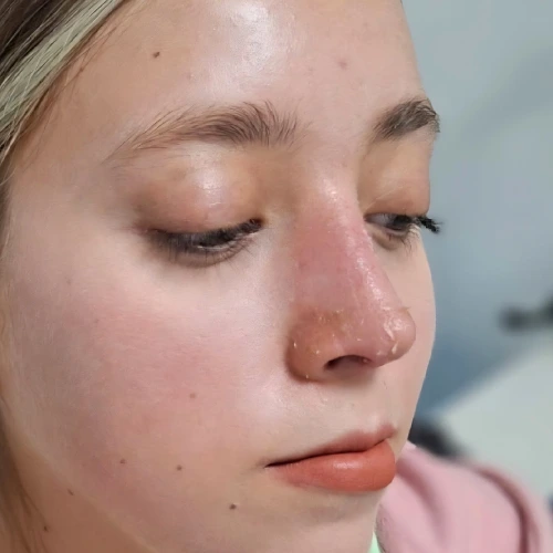 Comparativa Dr.Luis Sagrero (10) Rinoplastia en Zacatecas