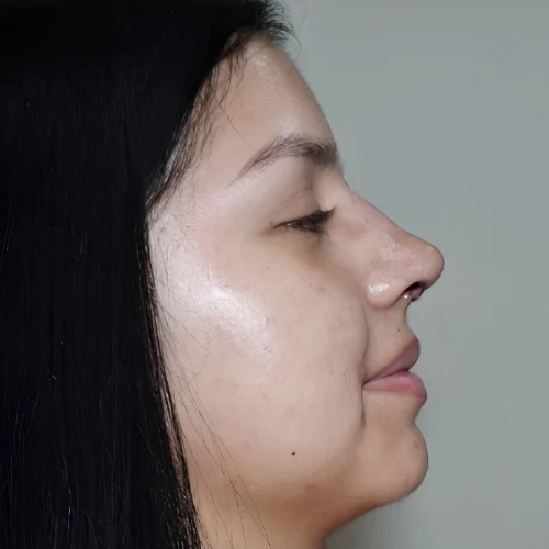 Comparativa Dr.Luis Sagrero (2) Rinoplastia en Zacatecas
