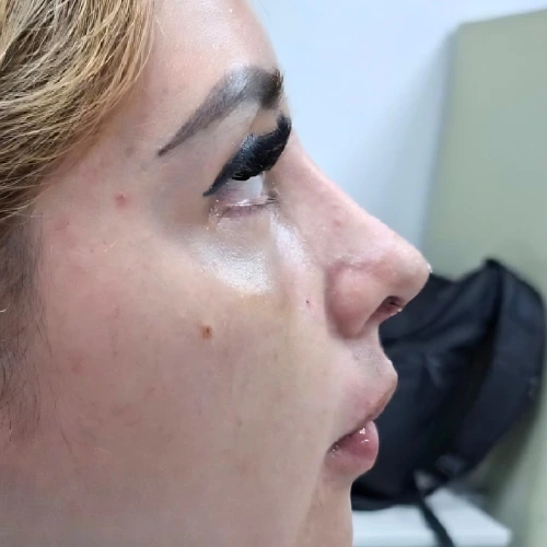 Comparativa Dr.Luis Sagrero (4) Rinoplastia en Zacatecas