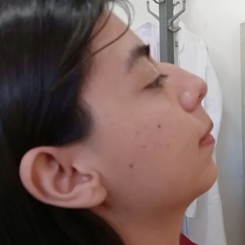Comparativa Dr.Luis Sagrero (5) Rinoplastia en Zacatecas