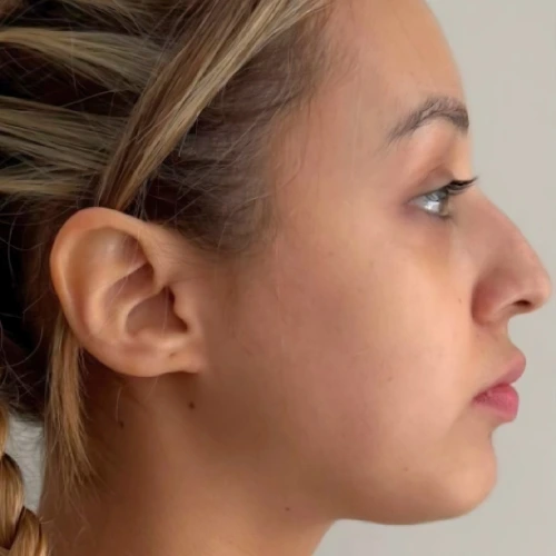 Comparativa Dr.Luis Sagrero (7) Rinoplastia en Zacatecas