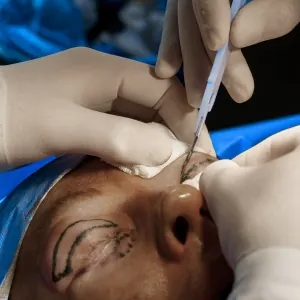 duele-la-blefaroplastia