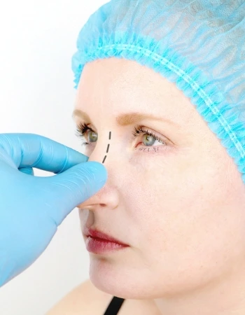 rinoplastia Rinoplastia en Zacatecas
